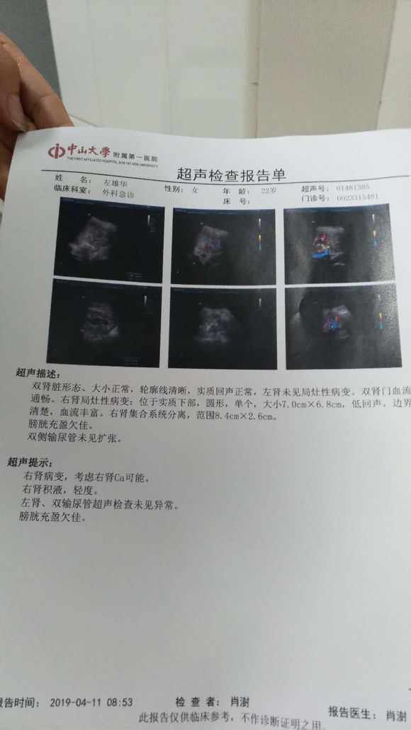 有肾癌的朋友们进来看下，这是什么期的万分感谢